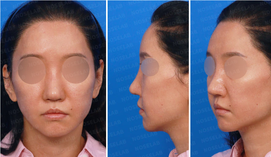 Preoperative consultation photos for revision rhinoplasty — showing frontal, 45-degree oblique, and side views before surgery. The images display nasal asymmetry and structural collapse prior to reconstruction using autologous rib cartilage.