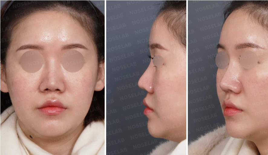 Preoperative consultation photos showing frontal view, left oblique view, and left side profile of a patient with columellar retraction and pinched right alar deformity before revision closed rhinoplasty.