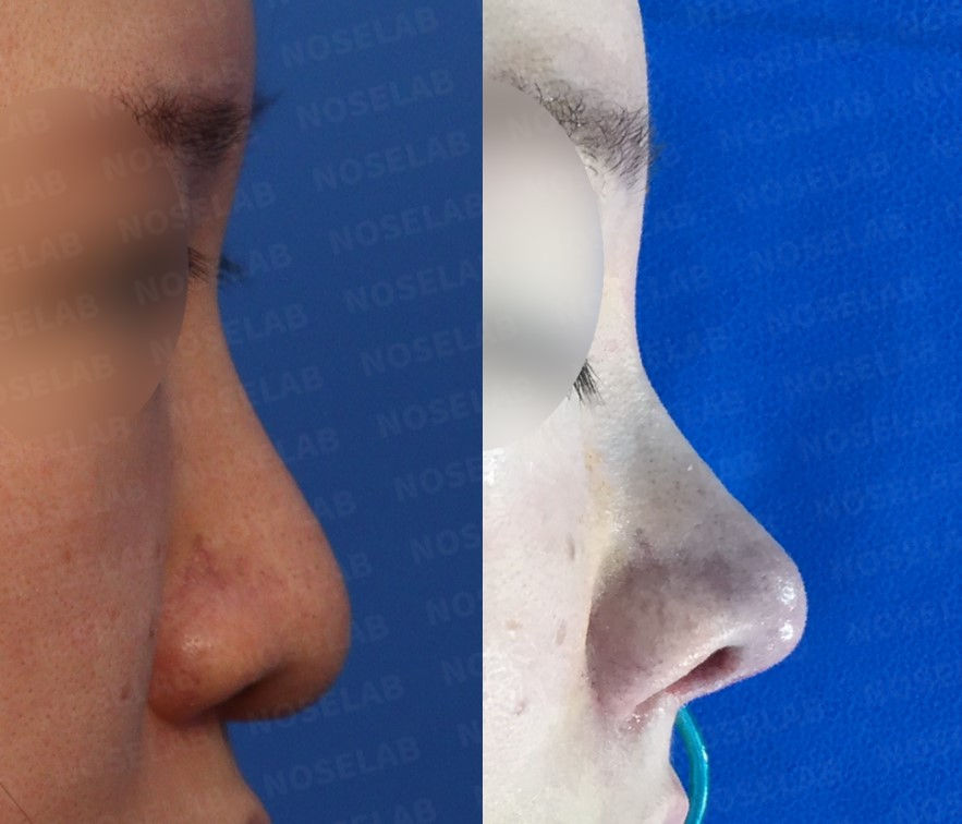 Before and after Closed Rhinoplasty Seoul – side view showing correction of droopy, bulbous, and deviated nose using autologous rib cartilage at NoseLab Plastic Surgery.
