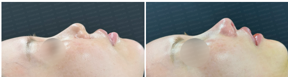 Side profile view before surgery (left) after surgery (right)