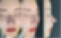 Frontal, oblique side, and side view photos immediately after closed rhinoplasty, showing improved nasal tip projection, refined bridge, and balanced profile.