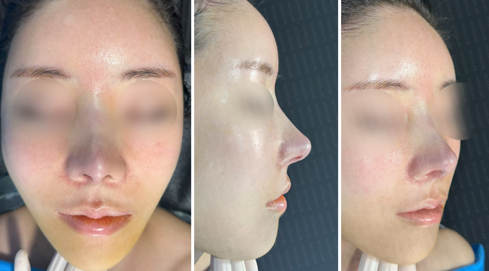 Photos taken immediately after surgery, frontal view, 45-angle view, and side profile.