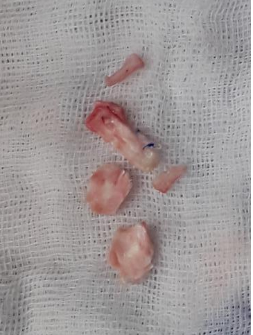 Removed Gore-Tex implant fragments during revision rhinoplasty showing extracted synthetic material and surrounding tissue