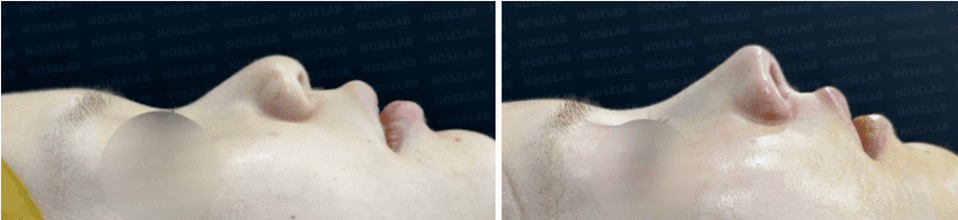 0-degree side profile before-and-after photos showing sharper nasal tip and improved nasolabial angle, reducing the appearance of protruding maxilla.