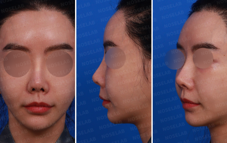 Repeated Dermal Absorption Nose Revision – Preoperative Right Oblique, Side, and Frontal View Photos