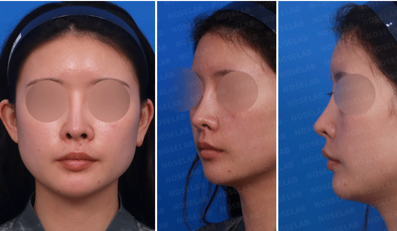 Preoperative design consultation photos for closed rhinoplasty Korea and upturned tip correction - Frontal view, left oblique view, left side view