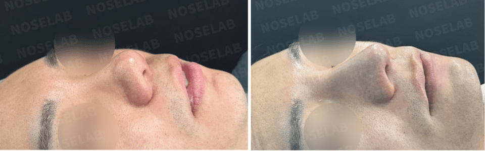Before and after bulbous nose correction with chin surgery – 45-degree oblique view highlighting refined nose tip and improved chin contour