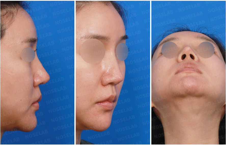 Preoperative views before closed rhinoplasty Korea for permanent filler removal showing right side and nostril views