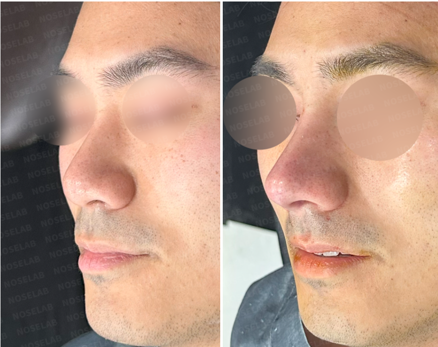 Before and immediately after oblique view photos of a male patient’s rhinoplasty – left shows wide nasal tip, right shows improved nasal symmetry and refined bridge after surgery
