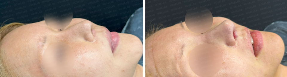 45-degree angle view before surgery (left) and after surgery (right).