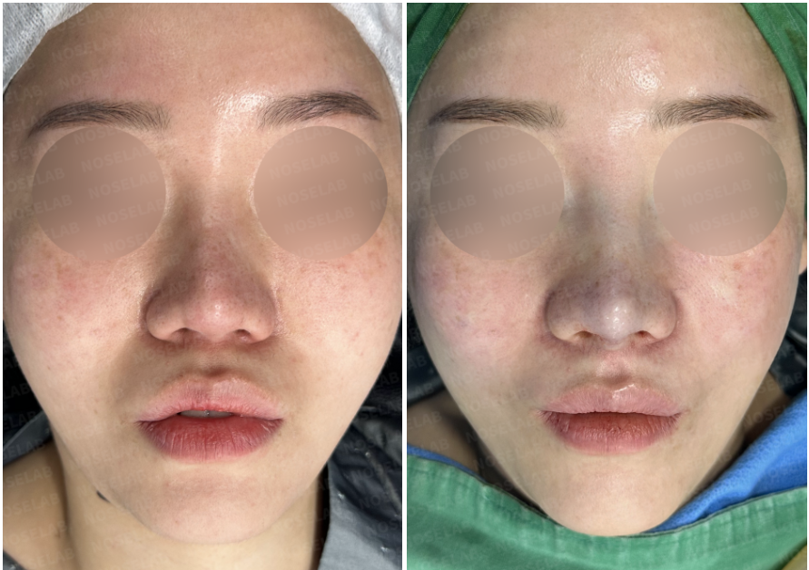 Before and immediately after surgery frontal view showing restoration of columellar height and correction of right alar deformity following revision closed rhinoplasty with autologous rib cartilage reconstruction.