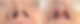 Before and immediately after closed rhinoplasty: nostril view comparison.