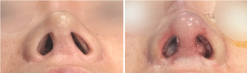Before and immediately after closed rhinoplasty: nostril view comparison.