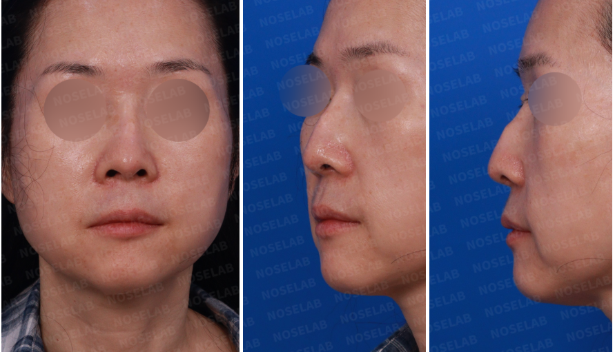 Preoperative photos before silicone implant calcification correction surgery – frontal, left oblique, and side views showing dorsal hump and nasal deviation caused by 30-year-old silicone capsule.