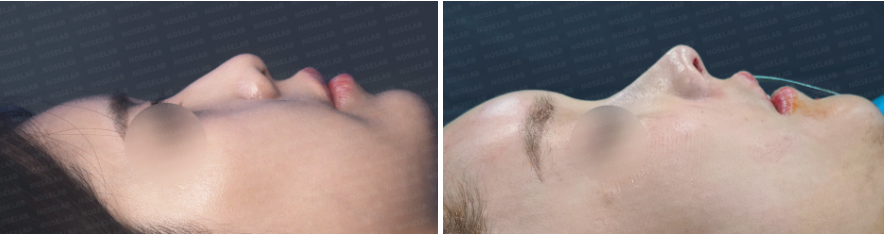 Protruding mouth rhinoplasty – before and after side profile comparison photos (left: before surgery, right: after surgery)