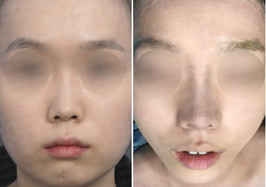 Short nose rhinoplasty – before and after comparison frontal view (left before, right after)