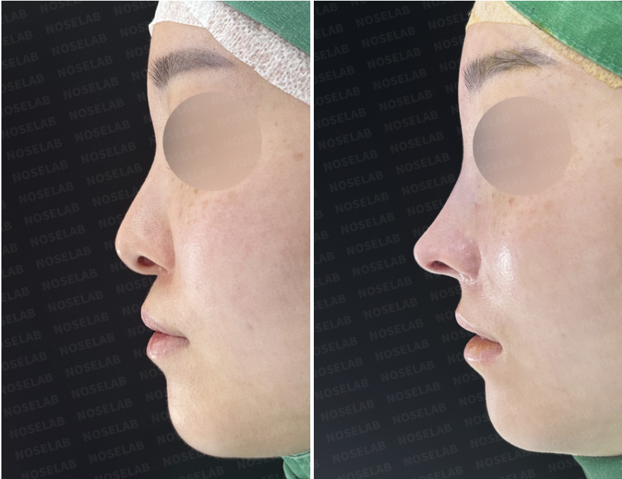 Before and after photos of Droopy Columella Correction – right side view showing lifted columella, refined nasal line, and improved nasolabial angle.