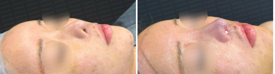 Corrective rhinoplasty after nostril reduction – before surgery (left) and immediate postoperative oblique view (right)
