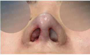 Immediately after revision rhinoplasty – nostril view showing improved symmetry and internal nasal structure after contracture correction