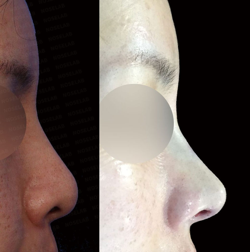 Before and after images showing side view improvement after Deviated and Upturned Nose Correction – Closed Rhinoplasty Korea
