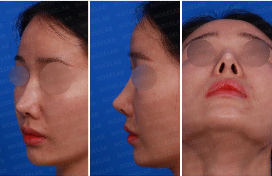 Pre-surgery design consultation photos: right side view, right oblique side view, and nostril view