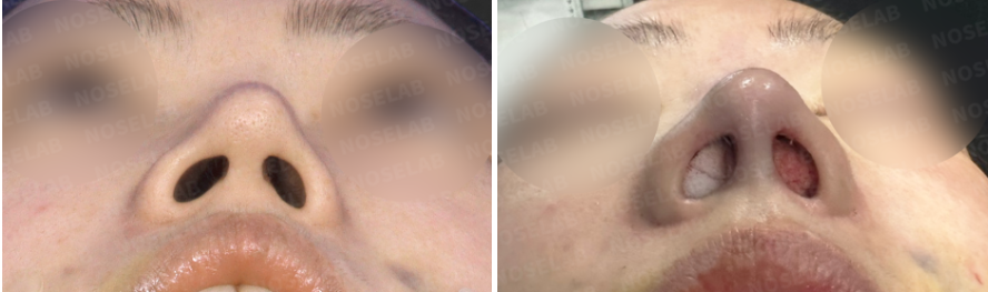 Nostril base view comparison before and immediately after revision rhinoplasty using rib cartilage for correcting nasal deviation and drooping tip