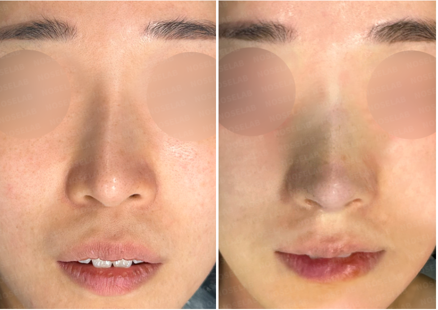 Before and immediately after structural reconstruction rhinoplasty – frontal view showing improved nasal symmetry and refined tip definition.