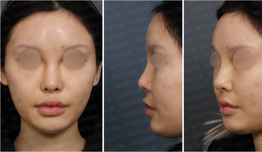 Preoperative design consultation photos showing high radix, crooked nasal bridge, and nasal asymmetry from frontal, left oblique, and left lateral views.