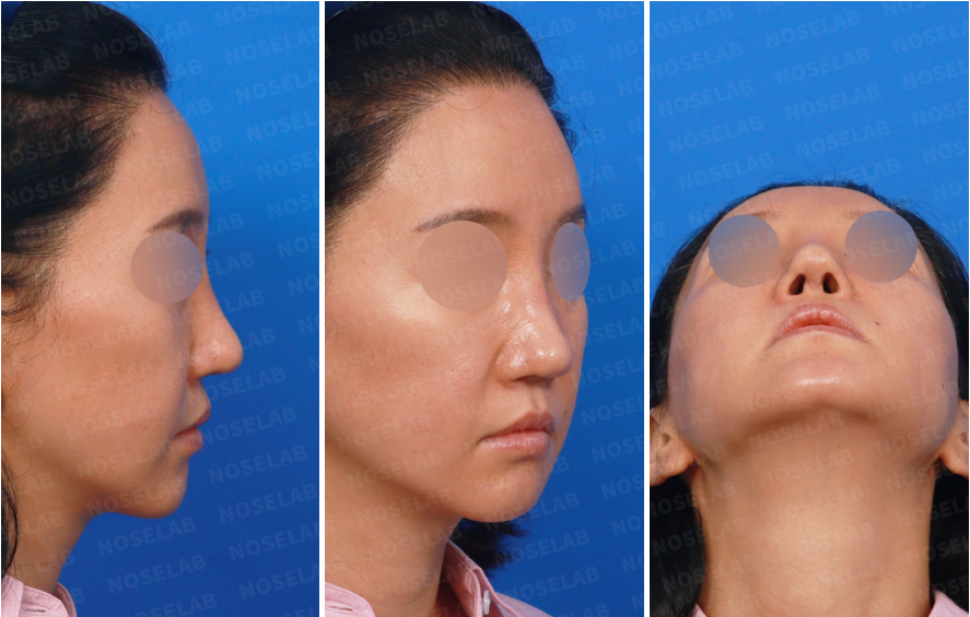 Preoperative consultation photos for revision rhinoplasty — showing right side, 45-degree oblique, and nostril views. These images illustrate nasal deviation, collapsed tip support, and asymmetry before reconstruction using autologous rib cartilage.