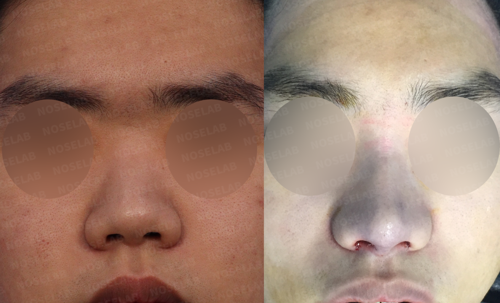 Frontal view comparison showing reduced nasal width and improved tip definition