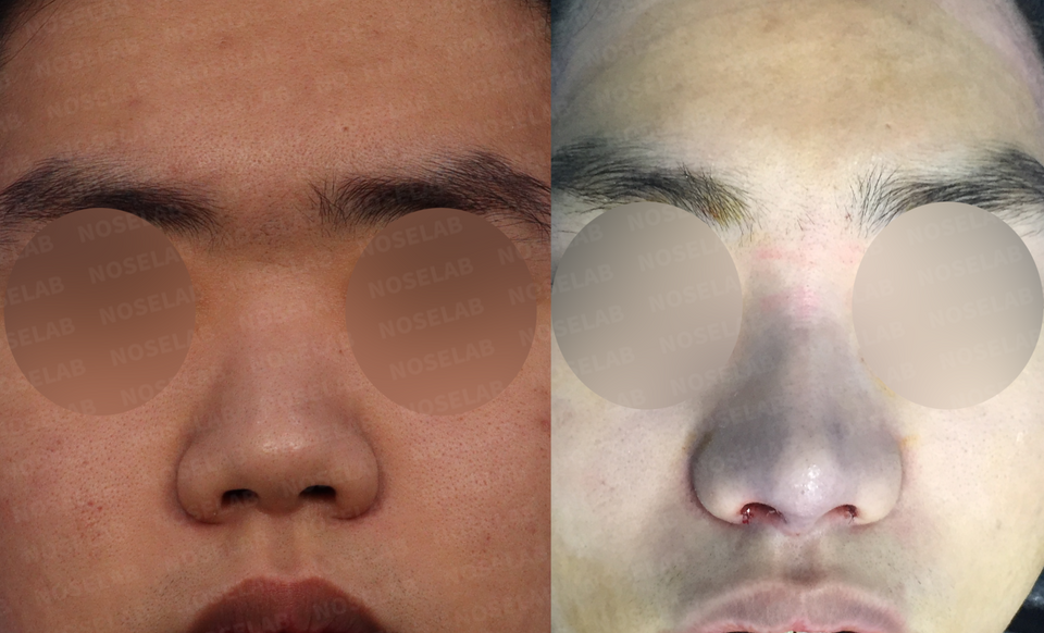 Frontal View – Bulbous Nose Correction Korea Showing Reduced Width and Balanced Nostril Exposure