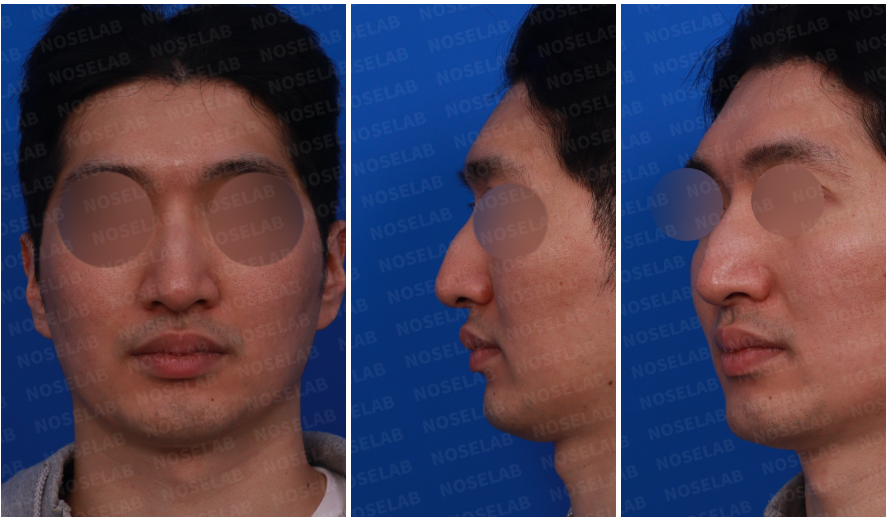 Preoperative consultation images for autologous rib cartilage rhinoplasty: frontal, left profile, and oblique views showing dorsal hump, elongated nose, and nasal asymmetry.