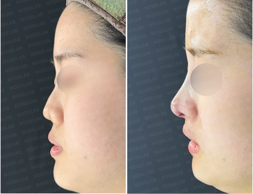 Correcting Nostril Stenosis – Before (left) and immediately after (right) revision rhinoplasty side view photos.
