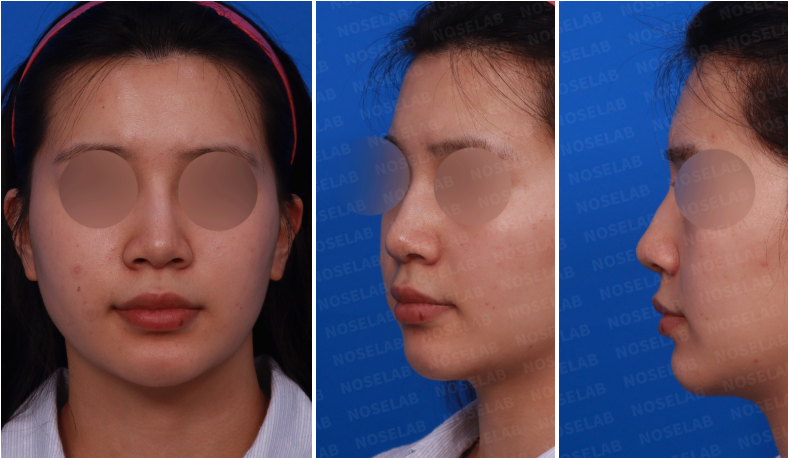 Preoperative photos before bulbous tip correction and foreign substance removal: Frontal, left oblique, and left profile view.