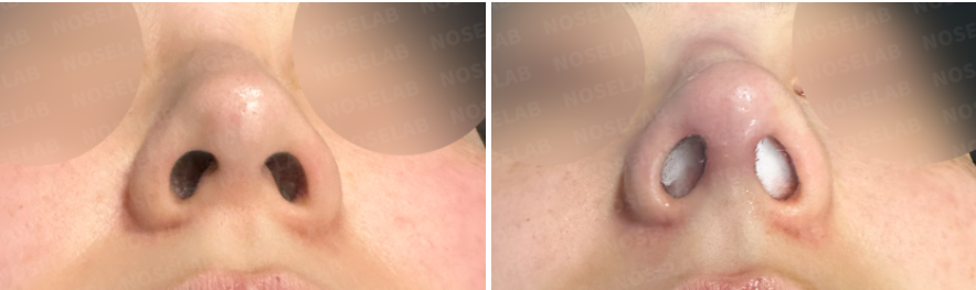 Nostrils before surgery (left) after surgery (right)