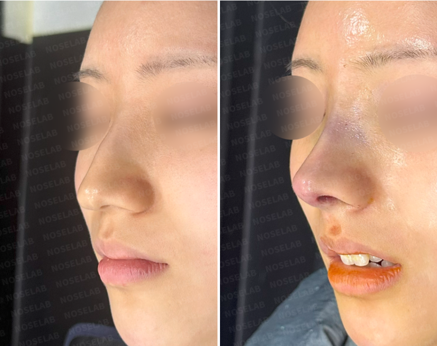 Before and immediately after hump nose correction – 45-degree view showing reduced dorsal hump, smoother nasal bridge, and enhanced nasal tip shape.