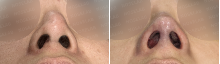 Nostril view comparison showing preoperative nasal airway narrowing on the left and immediate postoperative appearance on the right after septal reconstruction.