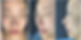 Immediately after closed rhinoplasty in Korea: Frontal view, side view, and oblique side view photos.