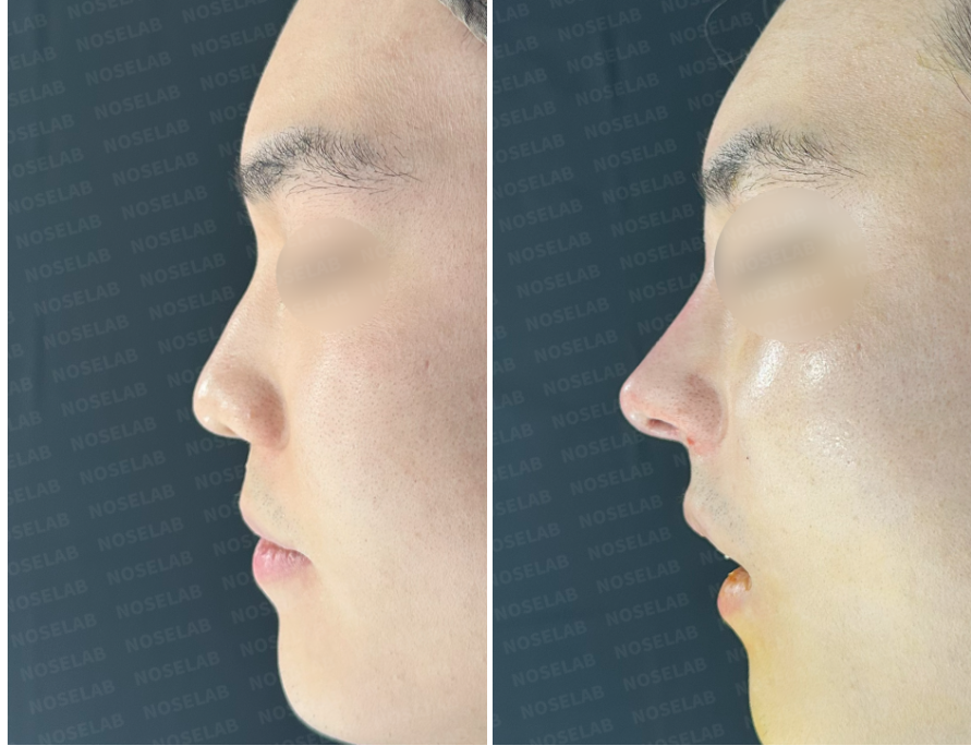 Enhancing nasal height & resolving nasal obstruction – pre- and immediate post-surgery right side view photos of patient at Nose Lab Clinic.