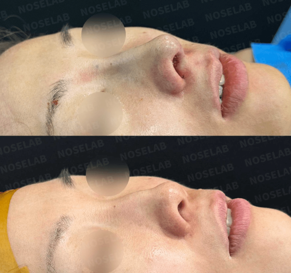 Before and after 45-degree view – bumpy and deviated nose correction using self-rib cartilage through closed rhinoplasty (Noselab Clinic)