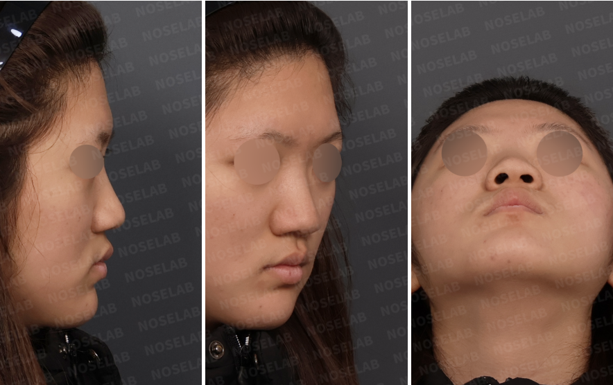 Preoperative design consultation photos showing bulbous and wide nasal tip, flared alar width, and nostril asymmetry from right lateral, right oblique, and basal views.