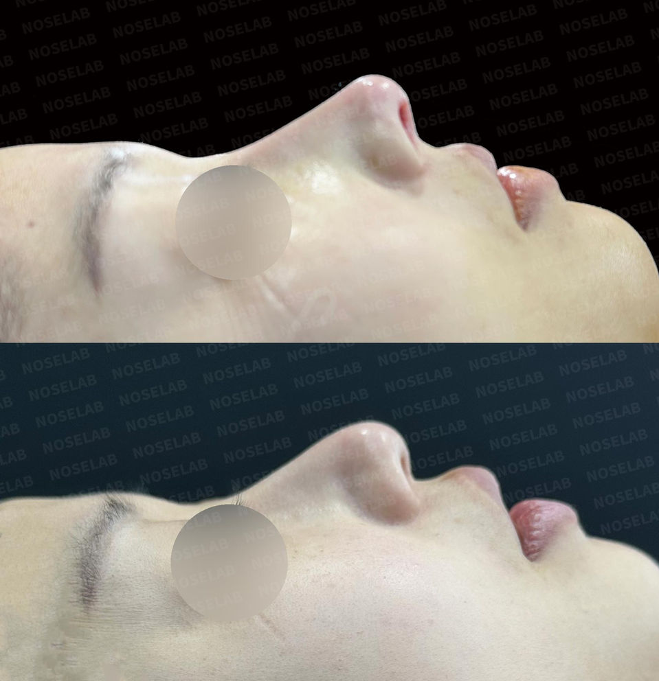 Right 90-degree lateral view before and after Deviated and Droopy Nose Correction – Closed Rhinoplasty Korea