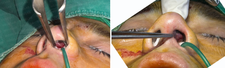 intraoperative view of silicone exposure rhinoplasty showing granulation tissue removal and infected nasal tissue inside the nostril during closed rhinoplasty Korea