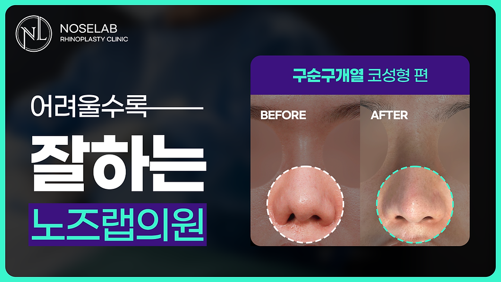 YouTube thumbnail showing before-and-after results of cleft lip and palate rhinoplasty, highlighting improved nasal symmetry and refined tip contour after reconstructive surgery at Nose Lab Clinic.