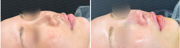 45-degree angle view before surgery (left) after surgery (right)