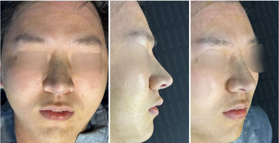 Photos taken immediately after surgery, frontal view, 45-angle view, and side profile.