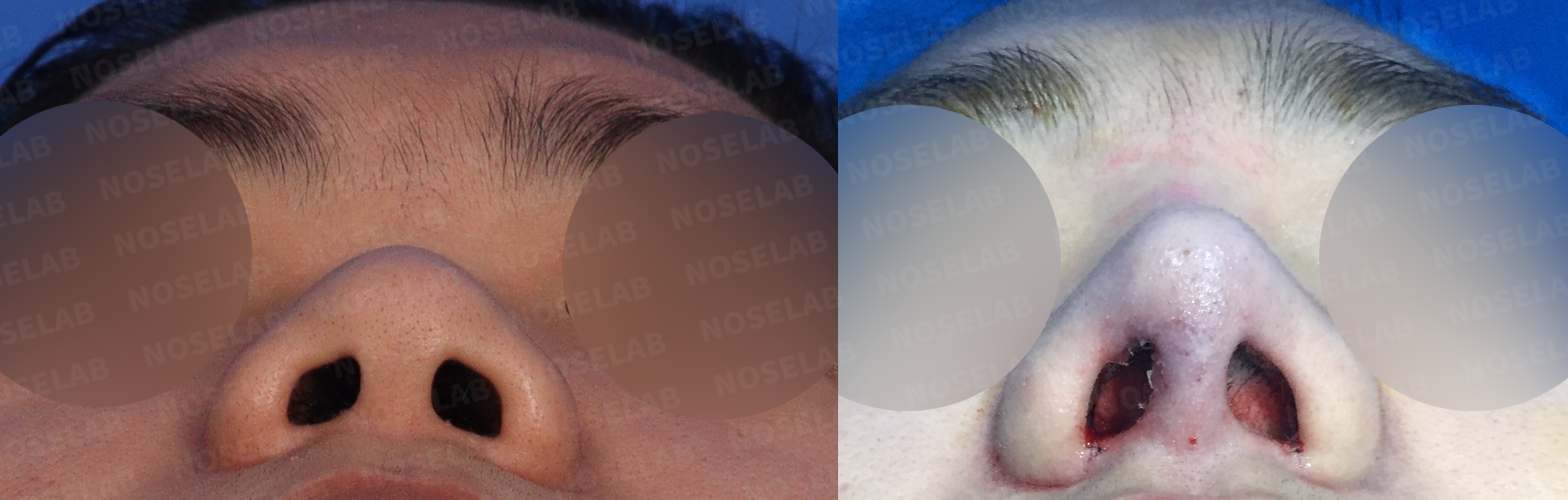Base view showing improved nostril symmetry and columellar positioning