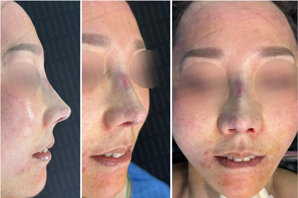90° angle | 45° angle | Frontal view. Photos taken after the surgery with the consent of the patient.