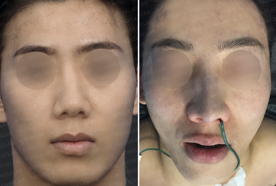 Frontal view before and after Closed Rhinoplasty Korea, showing improvement of retracted columella and nasal asymmetry.