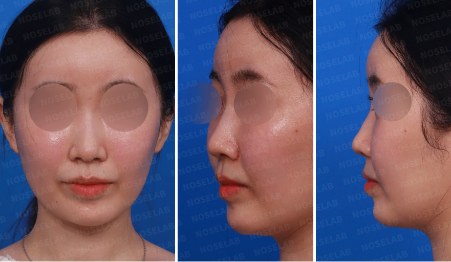 Pre-surgery frontal, oblique, and side views showing flat nose and bulbous tip before flat nose correction with autologous rib cartilage